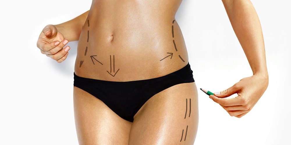 attractive Caucasian woman's abdomen and legs marked with lines for abdominal cellulite correction cosmetic surgery