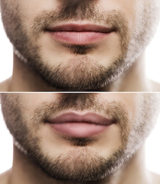 Aumento de labios resultado antes y después hombre